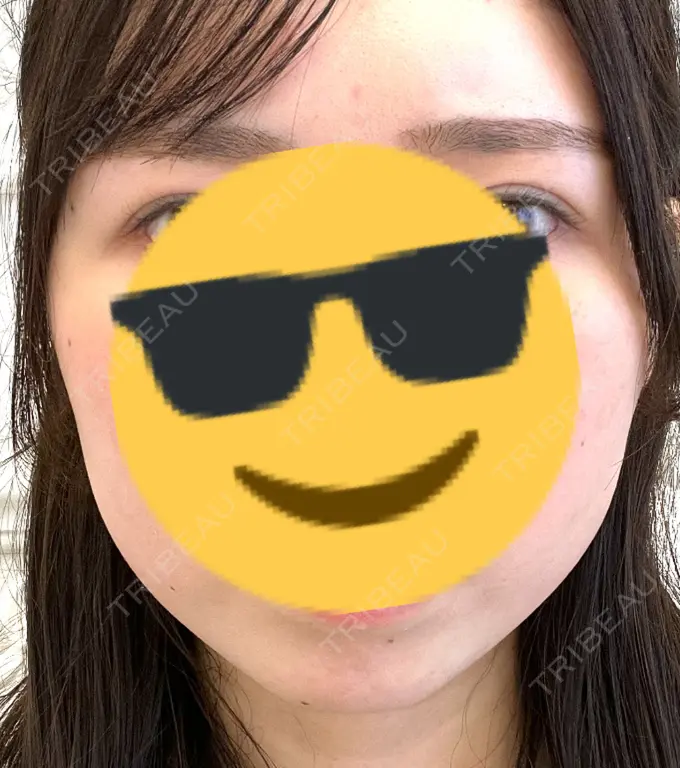 ハイフ（顔） A CLINIC（エークリニック） 横浜院 BEFORE メイン用