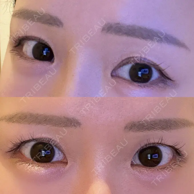 二重埋没 品川スキンクリニック 宇都宮院（※品川美容外科提携） BEFORE メイン用