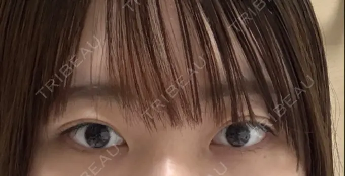 目頭切開 東京シンデレラ美容外科 池袋院 BEFORE メイン用