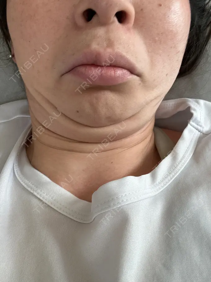 脂肪吸引注射（顔） 東京たかはしクリニック 練馬院 BEFORE メイン用