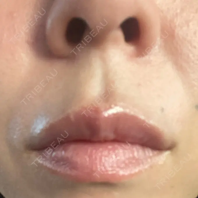 ボトックス（人中） veary clinic BEFORE メイン用