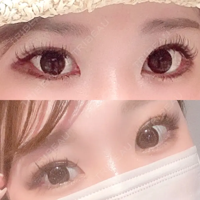 二重埋没 / 目頭切開 Brandnew Beauty Clinic BEFORE メイン用