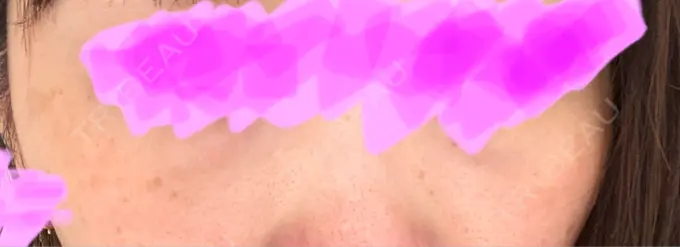 ピコレーザートーニング（美白・肝斑） アモーレクリニック 名古屋院 BEFORE メイン用