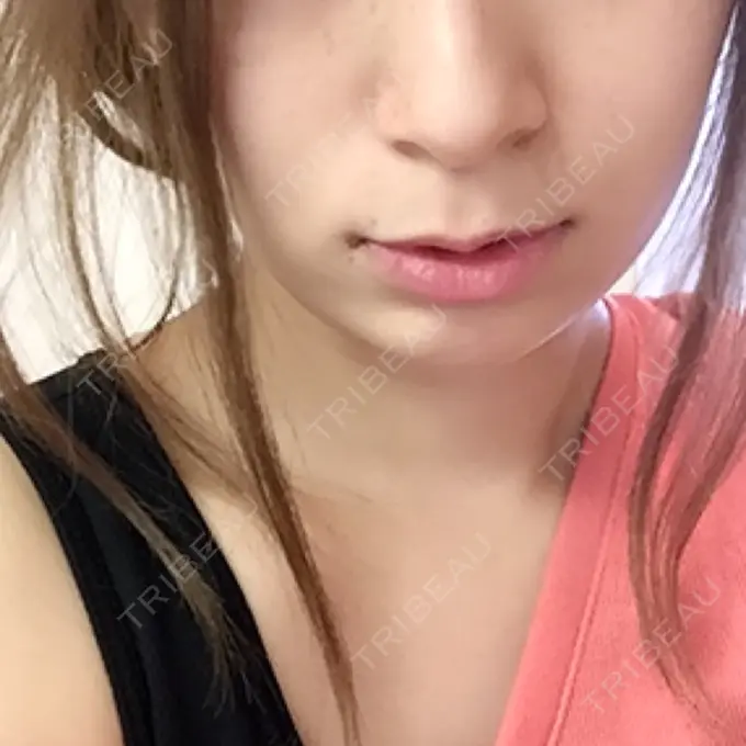 ヒアルロン酸注入（涙袋） / ヒアルロン酸注入（あご） 共立美容外科 梅田院 BEFORE メイン用