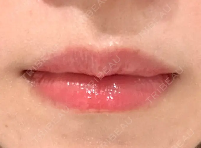 ヒアルロン酸注入（唇） フィラークリニック 新宿院 BEFORE メイン用