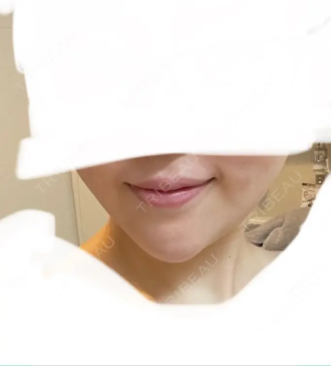 あごプロテーゼ ルラ美容クリニック 渋谷本院 BEFORE メイン用