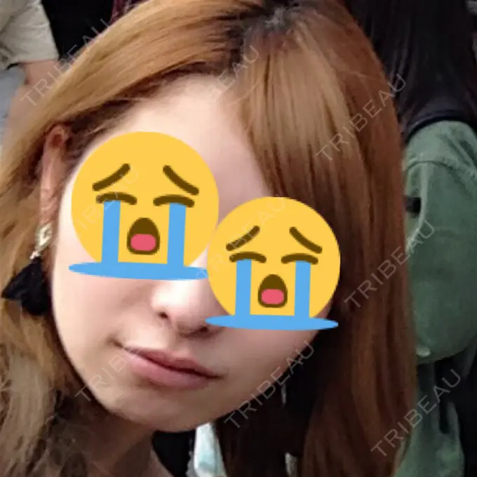 あごプロテーゼ / 輪郭修正 高崎TAクリニック BEFORE メイン用