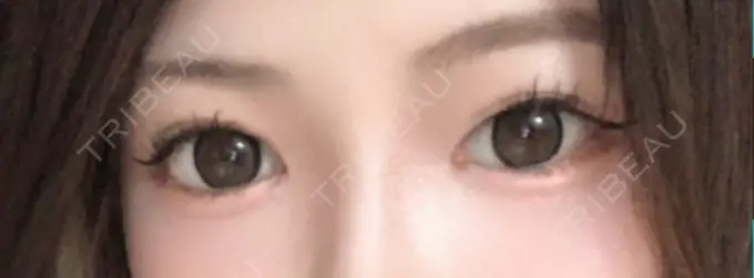 二重埋没 日本ウェルネス再生クリニック BEFORE メイン用