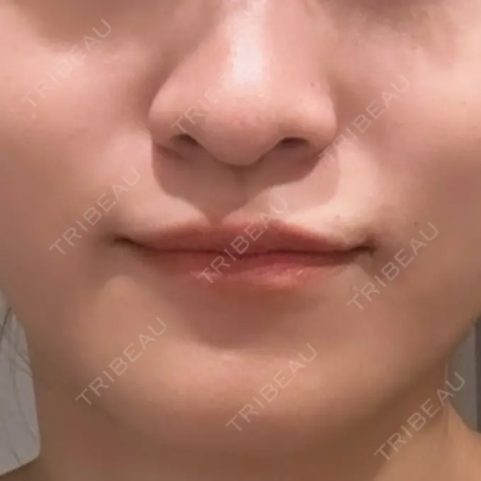 ヒアルロン酸注入（鼻翼基部） 豊洲内科・糖尿病 / 形成・美容外科クリニック BEFORE メイン用