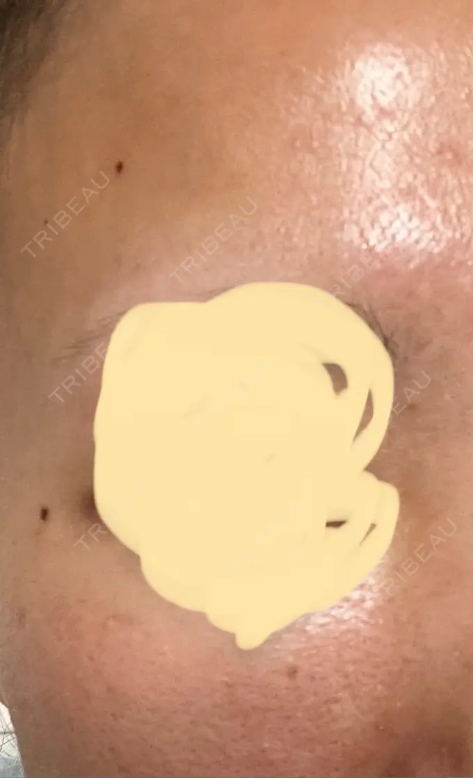 イオン導入 / ルメッカ ルラ美容クリニック 大宮院 / ルラスキンクリニック 大宮院 BEFORE メイン用