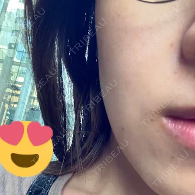 ピーリング（ハリ・ツヤ） MYCLINIC 西新宿 BEFORE メイン用