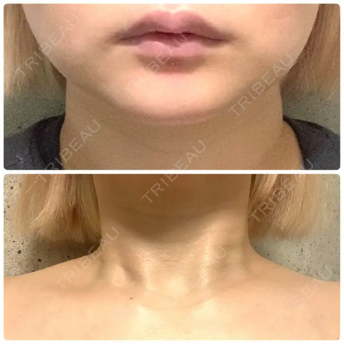 ボトックス（エラ・小顔） / ボトックス（肩） ルラ美容クリニック 上野院 BEFORE メイン用