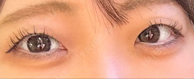 二重埋没 / 目頭切開 AI Beauty Clinic （エーアイ美容クリニック） BEFORE メイン用