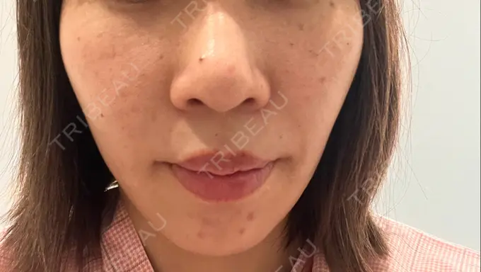 小鼻縮小（切開） / 人中短縮 / 鼻翼挙上 Otus Clinic 【オータスクリニック】 BEFORE メイン用