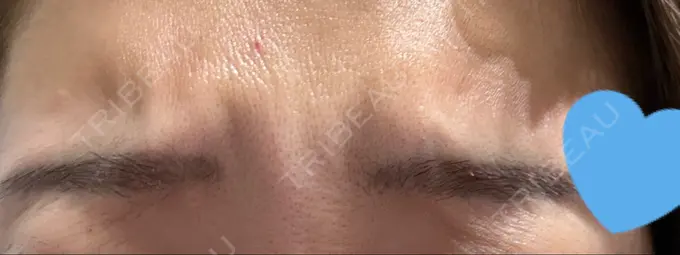 ボトックス（眉間） 湘南美容クリニック 博多院 BEFORE メイン用