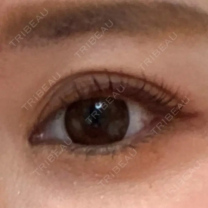 ベビーコラーゲン Mavie Beauty Clinic （マヴィービューティークリニック） BEFORE メイン用