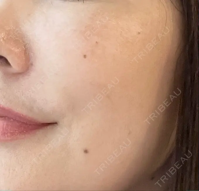 ボトックス（目尻） / ピーリング（ハリ・ツヤ） MYCLINIC 西新宿 BEFORE メイン用