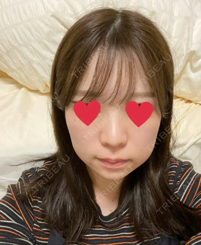 バッカルファット除去 / 脂肪吸引（顔） / ジョールファット除去 / ボトックス（エラ・小顔） 東京シンデレラ美容外科 池袋院 BEFORE メイン用