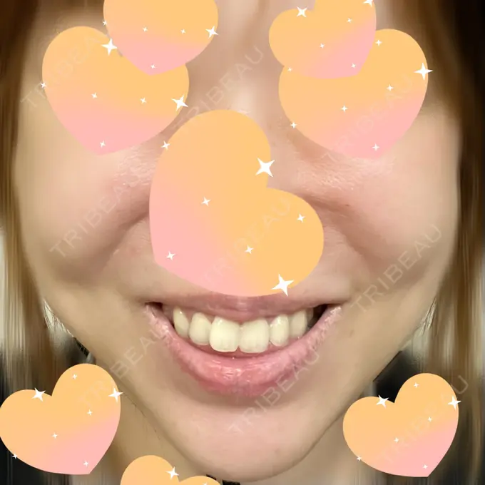 シワ取りボトックス みずほクリニック BEFORE メイン用