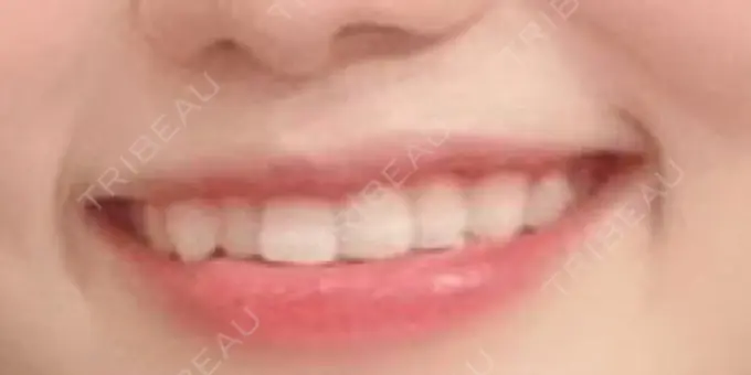 矯正（マウスピース） スマイルプランさくら歯科クリニック BEFORE メイン用