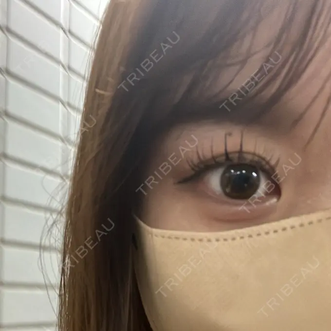 目頭切開 AI Beauty Clinic （エーアイ美容クリニック） BEFORE メイン用