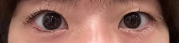 二重埋没 銀座S美容・形成外科クリニック BEFORE メイン用