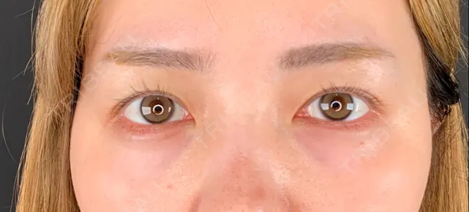 二重埋没 Brandnew Beauty Clinic BEFORE メイン用