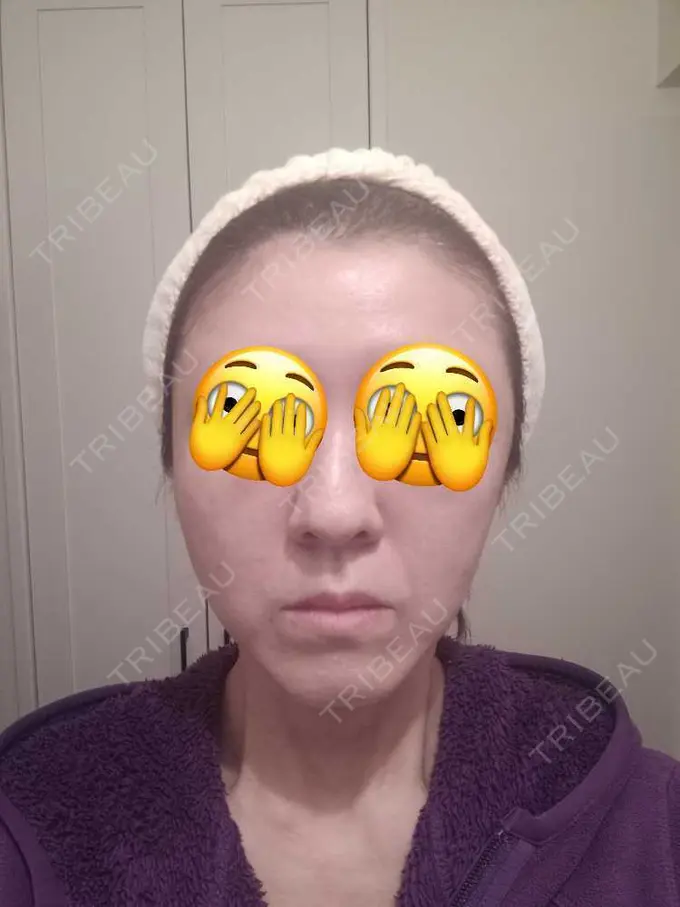 肌ヒアルロン酸注入（たるみ・シワ改善） / ルメッカ 豊洲内科・糖尿病 / 形成・美容外科クリニック BEFORE メイン用