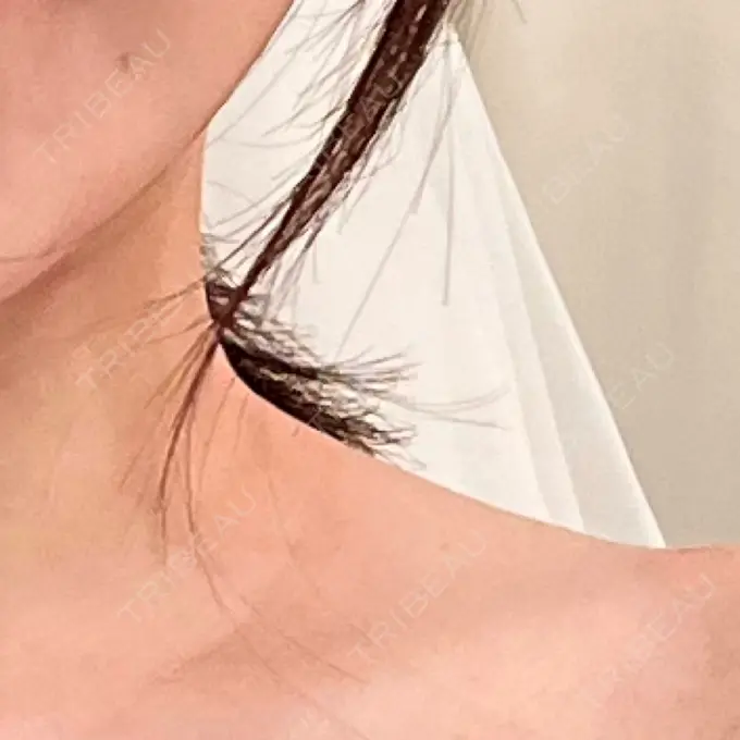 ボトックス（肩） L‘amour clinic Tokyo【ラムールクリニック東京】 BEFORE メイン用