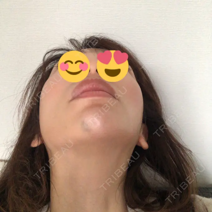 ボトックス（あご） TCB東京中央美容外科 柏院 BEFORE メイン用