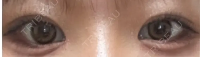 目頭切開 東京シンデレラ美容外科 池袋院 BEFORE メイン用