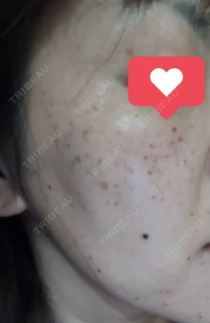 ルメッカ ルラ美容クリニック 渋谷本院 BEFORE メイン用