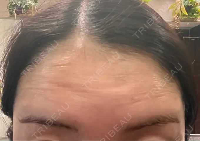 ボトックス（額） 湘南美容クリニック 大阪梅田本院 BEFORE メイン用