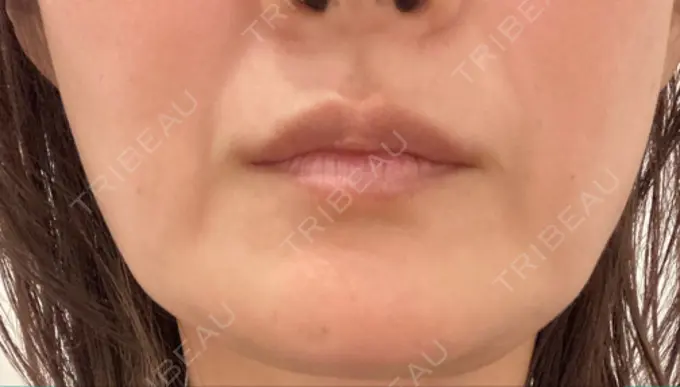 糸リフト / 脂肪吸引（顔） RIVER CLINIC（リバークリニック） BEFORE メイン用