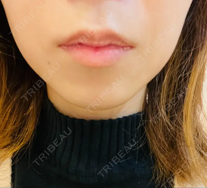 ヒアルロン酸注入（唇） 渋谷美容外科クリニック 新橋院 BEFORE メイン用