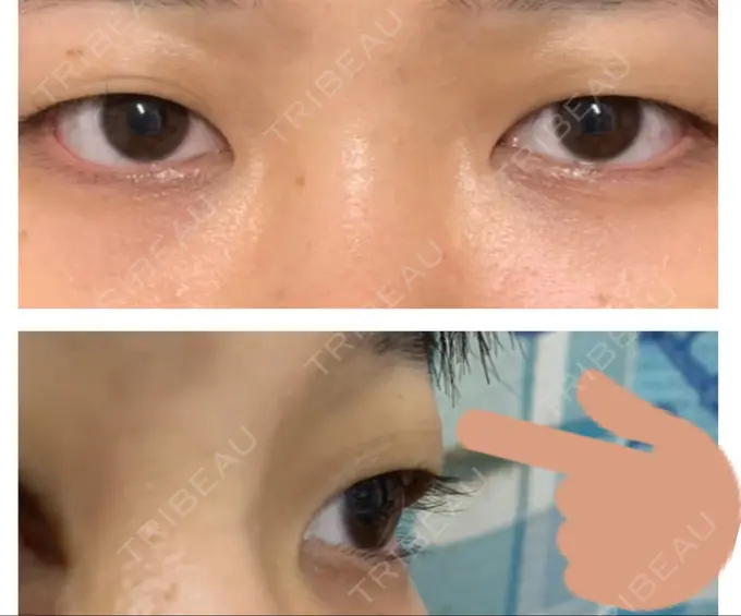 二重埋没 水の森美容クリニック 東京銀座院 BEFORE メイン用