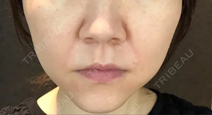 肌ヒアルロン酸注入（たるみ・シワ改善） 豊洲内科・糖尿病 / 形成・美容外科クリニック BEFORE メイン用