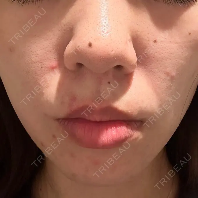 光治療（フォトフェイシャルなど） MKクリニック 日本橋院 BEFORE メイン用