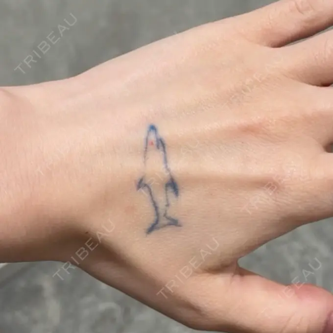 タトゥー除去 ziz CLINIC BEFORE メイン用