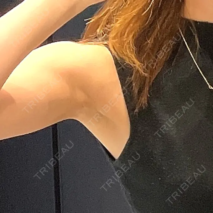 ワキ汗治療（レーザー） Fellez Clinic【フェルズクリニック】 BEFORE メイン用