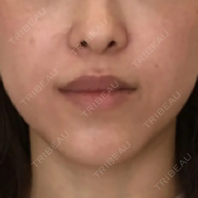 その他（目元） / その他（口元） 衣理クリニック表参道 BEFORE メイン用