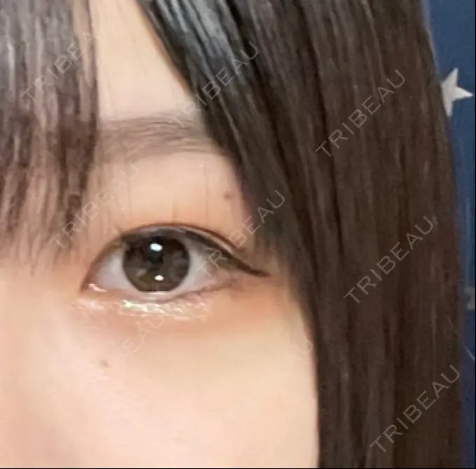 ほくろ・いぼ除去レーザー（肌） リッツ美容外科 大阪院 BEFORE メイン用