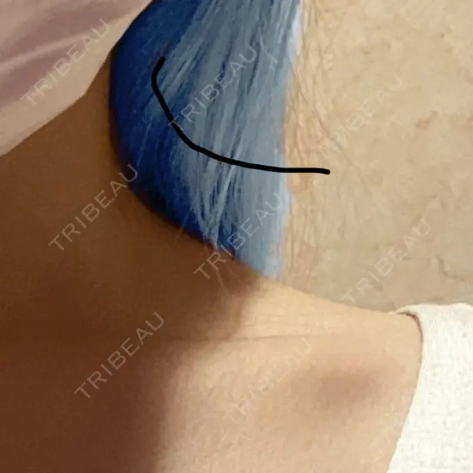 ボトックス（肩） 共立美容外科 梅田院 BEFORE メイン用