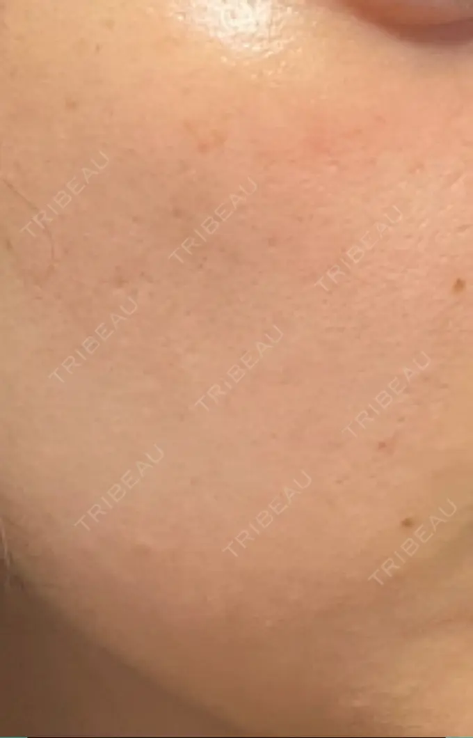 イオン導入 / ルメッカ ルラ美容クリニック 高田馬場院 BEFORE メイン用