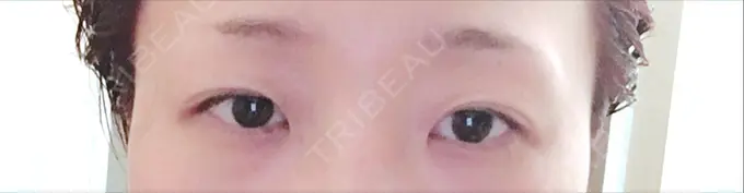 二重切開 城本クリニック 豊橋院 BEFORE メイン用