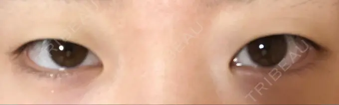 二重埋没 湘南美容クリニック 京都院 BEFORE メイン用