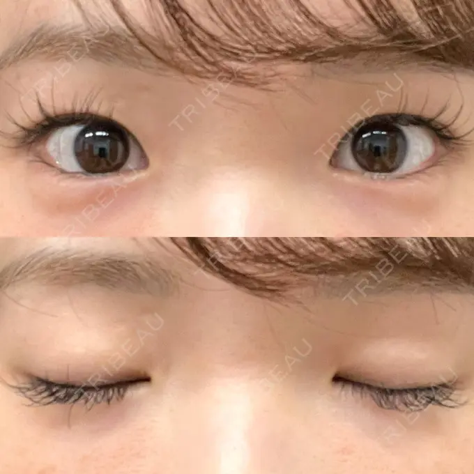 二重埋没 湘南美容クリニック 京都院 BEFORE メイン用