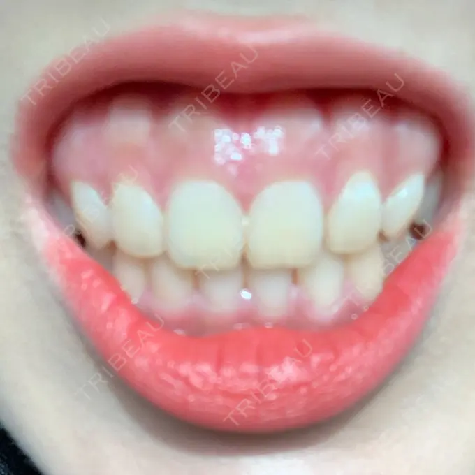 ガミースマイル手術 有楽町美容外科クリニック BEFORE メイン用