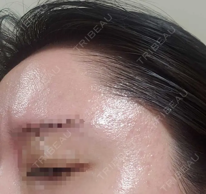 その他（肌） 湘南美容クリニック 仙台院 BEFORE メイン用