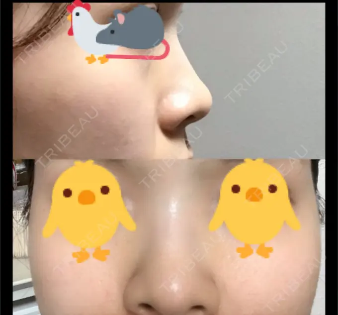 ヒアルロン酸注入（鼻） / ヒアルロン酸注入（あご） 恵聖会クリニック 京橋院 BEFORE メイン用